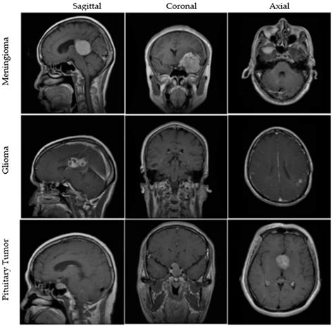 the villages brain mri